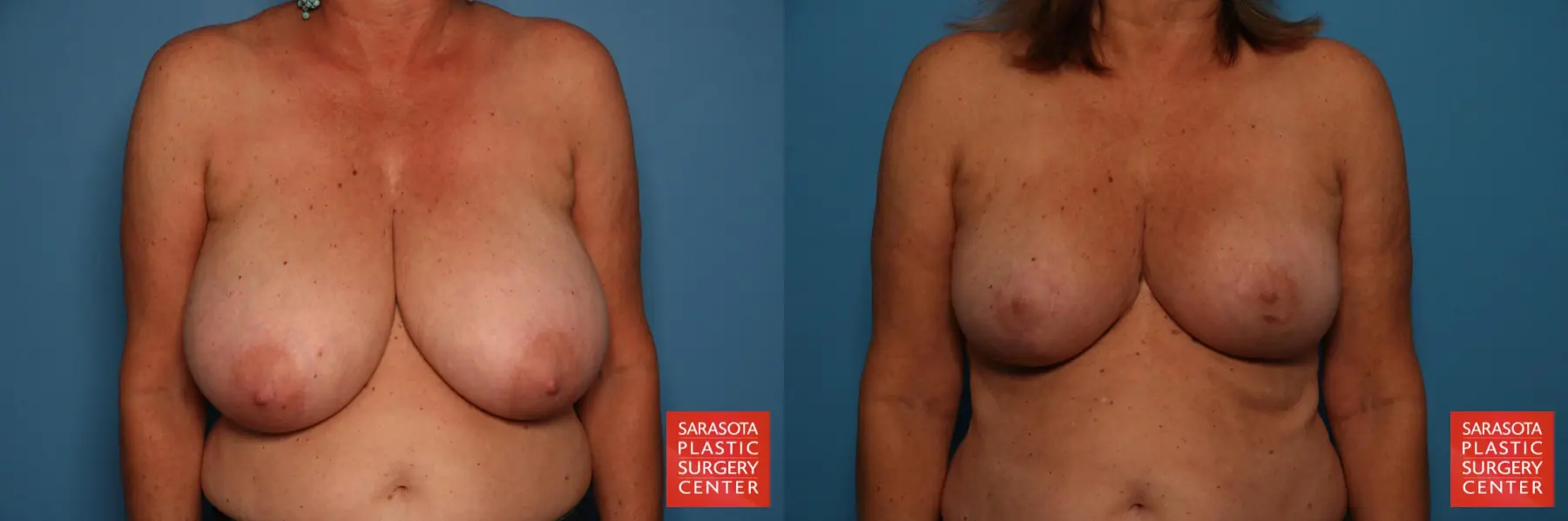 Breast Reduction: Patient 22 - Before and After  