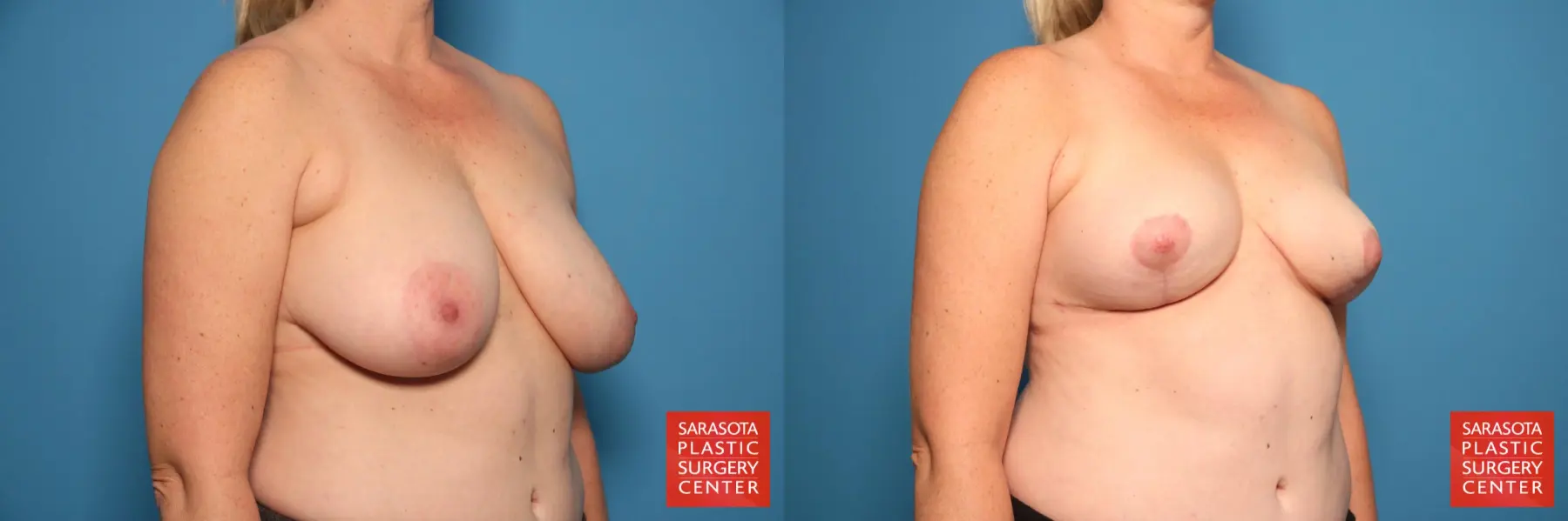 Breast Reduction: Patient 21 - Before and After 4