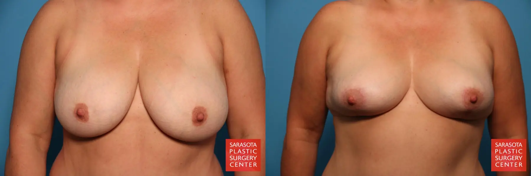 Breast Reduction: Patient 16 - Before and After  