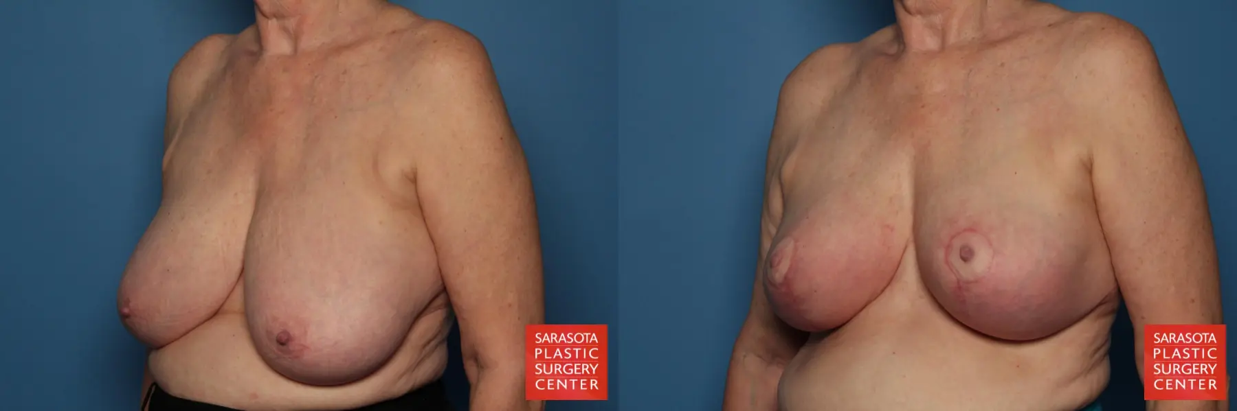 Breast Reduction: Patient 15 - Before and After 2