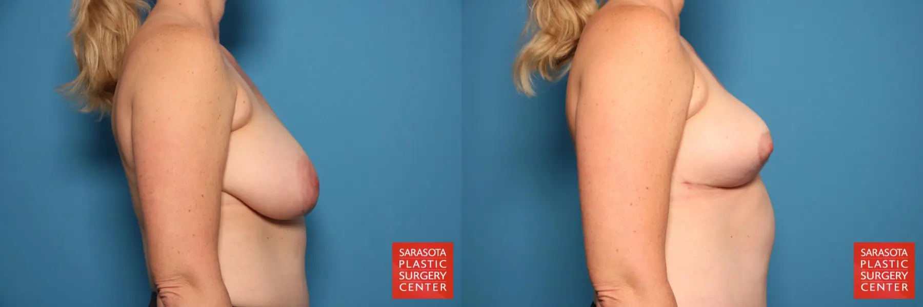Breast Reduction: Patient 21 - Before and After 5