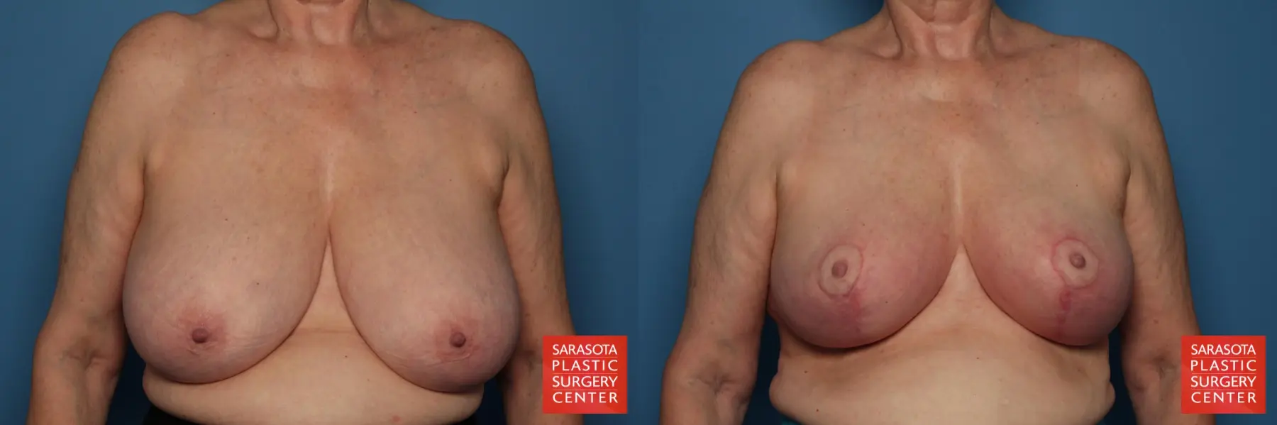 Breast Reduction: Patient 15 - Before and After  