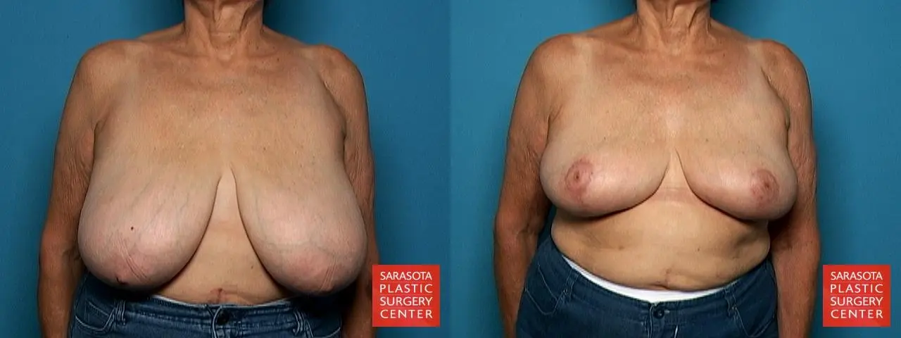 Breast Reduction: Patient 12 - Before and After  