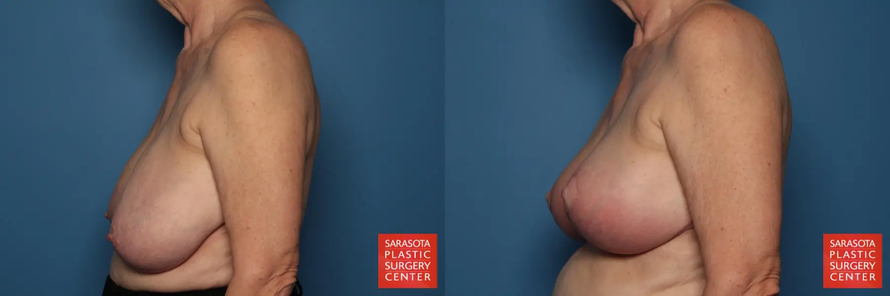 Breast Reduction: Patient 15 - Before and After 3