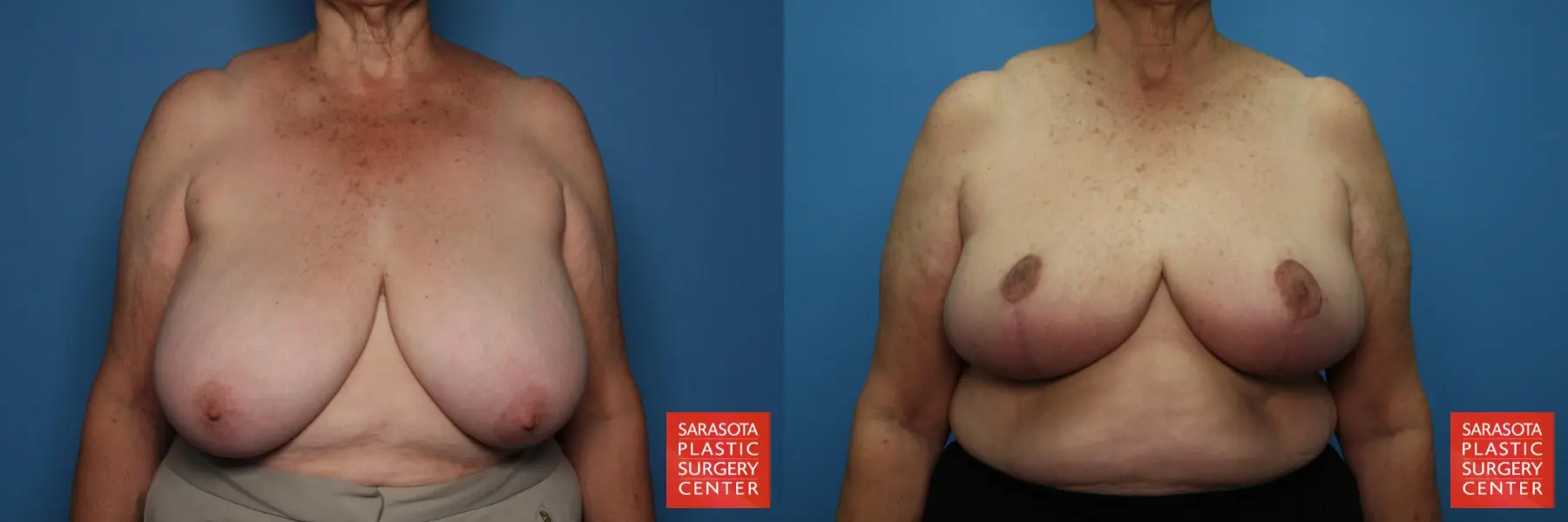 Breast Reduction: Patient 17 - Before and After  