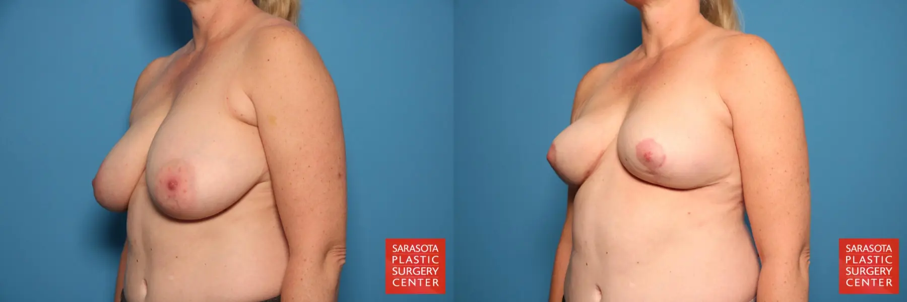 Breast Reduction: Patient 21 - Before and After 2