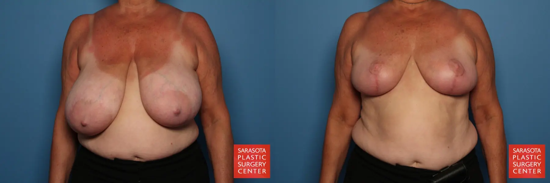 Breast Reduction: Patient 18 - Before and After  
