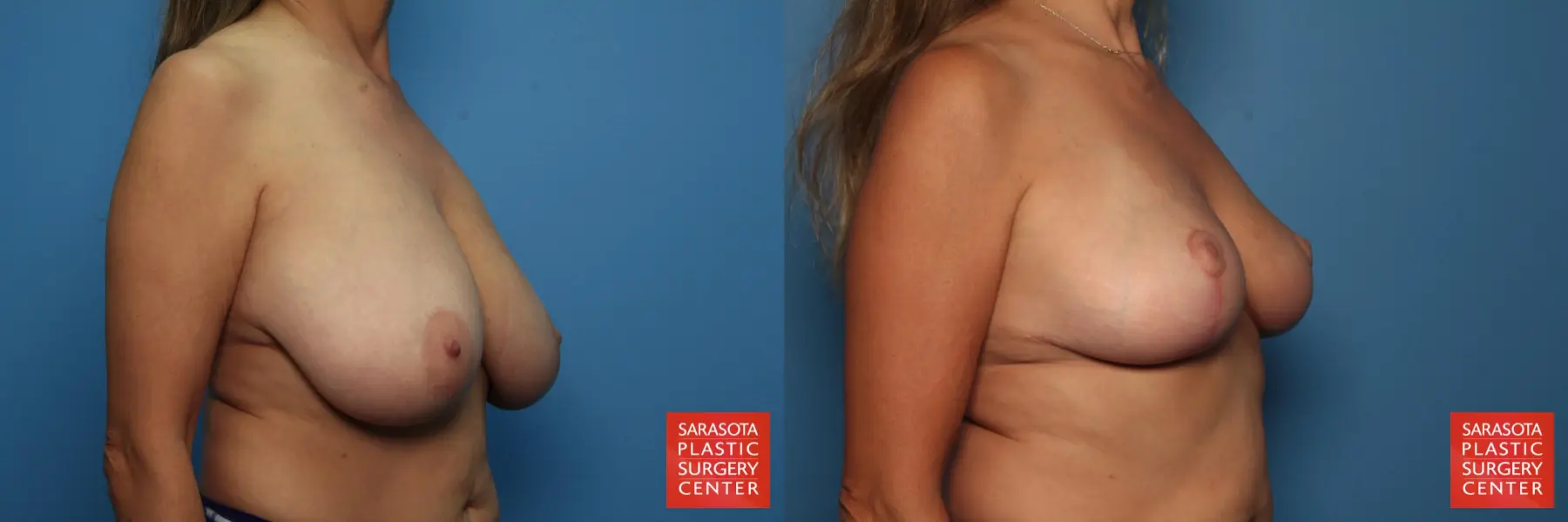 Breast Reduction: Patient 7 - Before and After 2