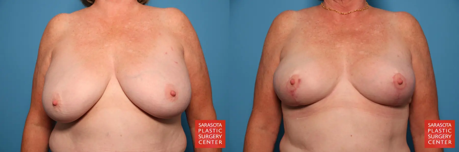 Breast Reduction: Patient 20 - Before and After  