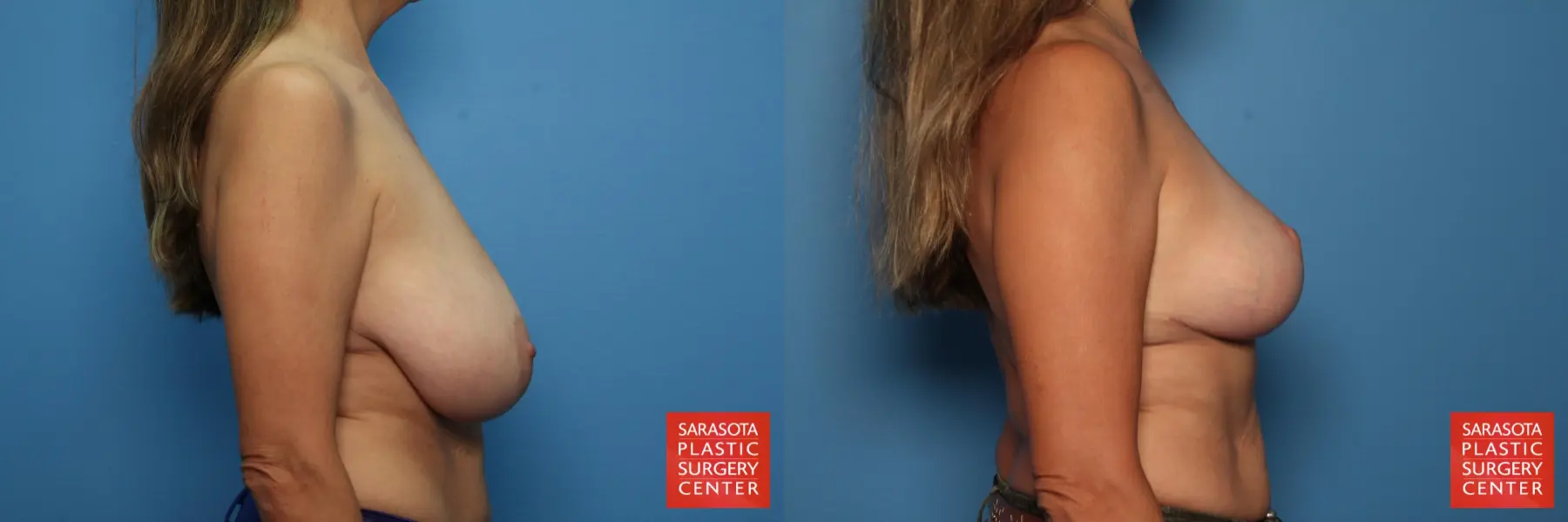 Breast Reduction: Patient 7 - Before and After 3