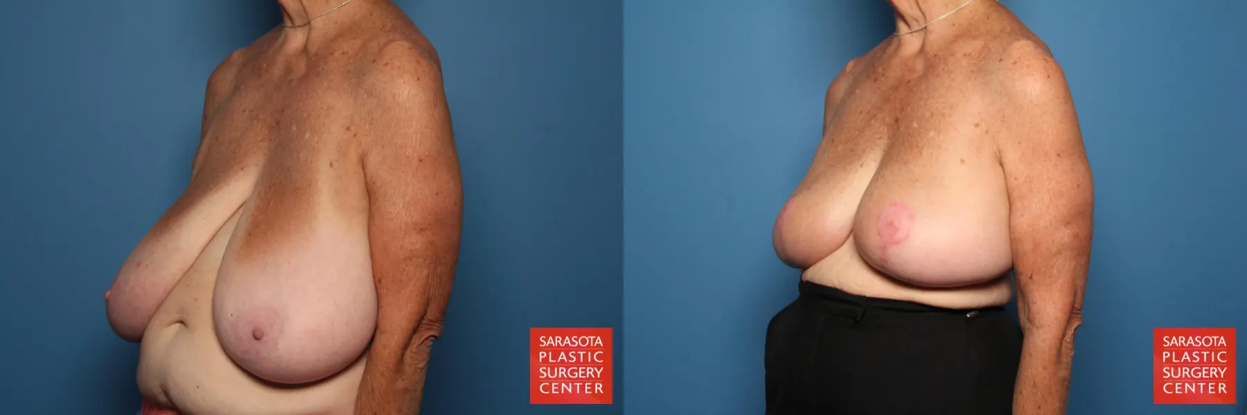 Breast Reduction: Patient 23 - Before and After 2