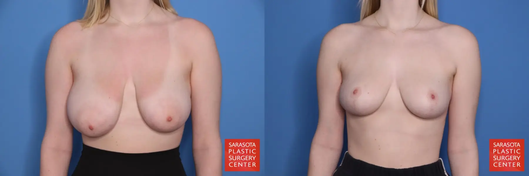 Breast Reduction: Patient 25 - Before and After  