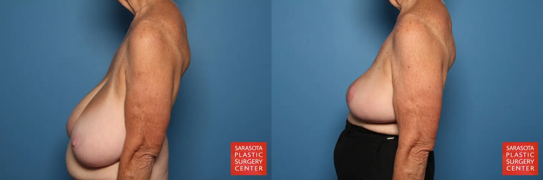 Breast Reduction: Patient 23 - Before and After 3