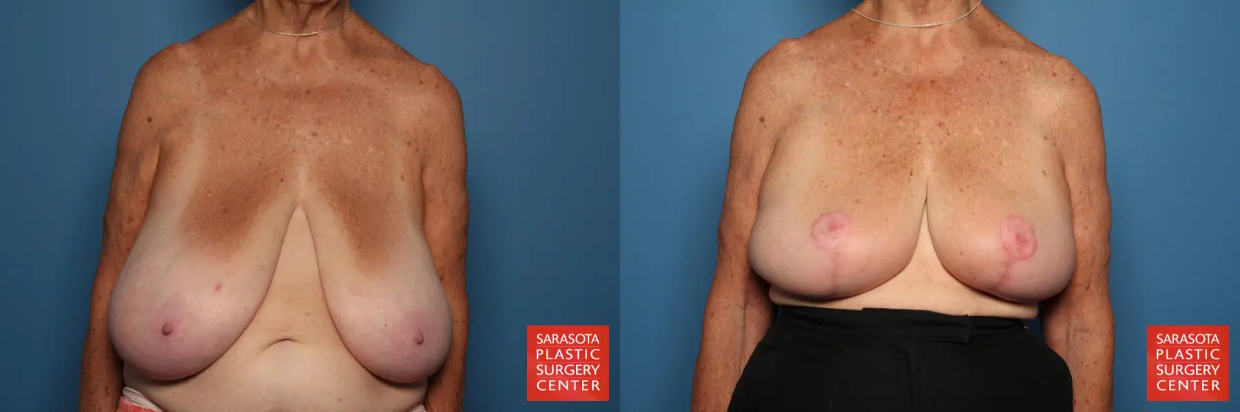 Breast Reduction: Patient 23 - Before and After  