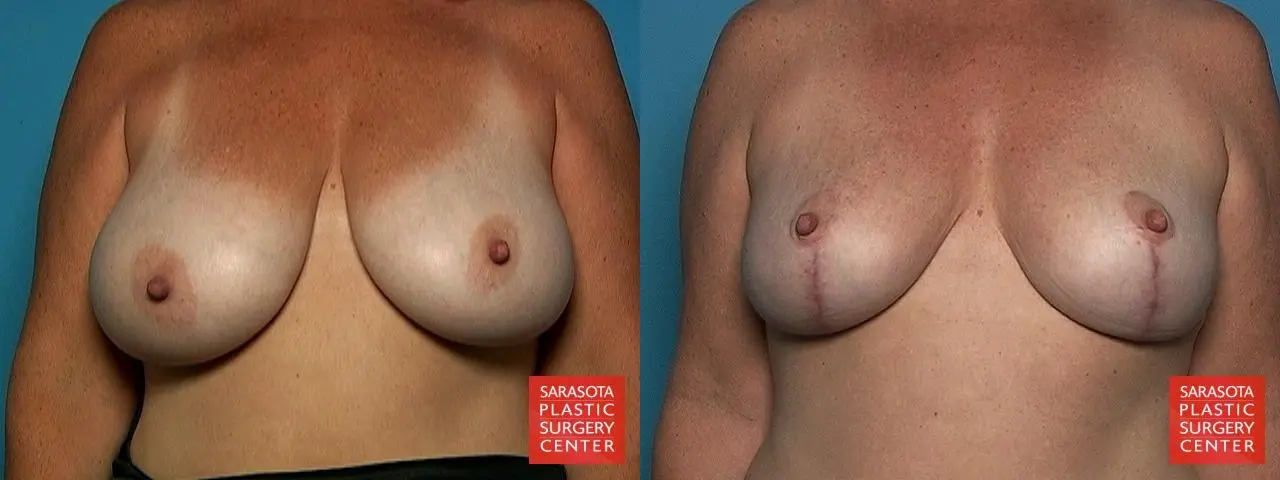 Breast Reduction: Patient 10 - Before and After  