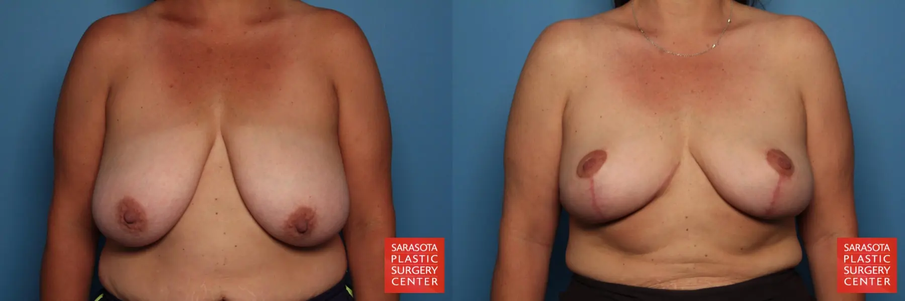 Breast Reduction: Patient 13 - Before and After  