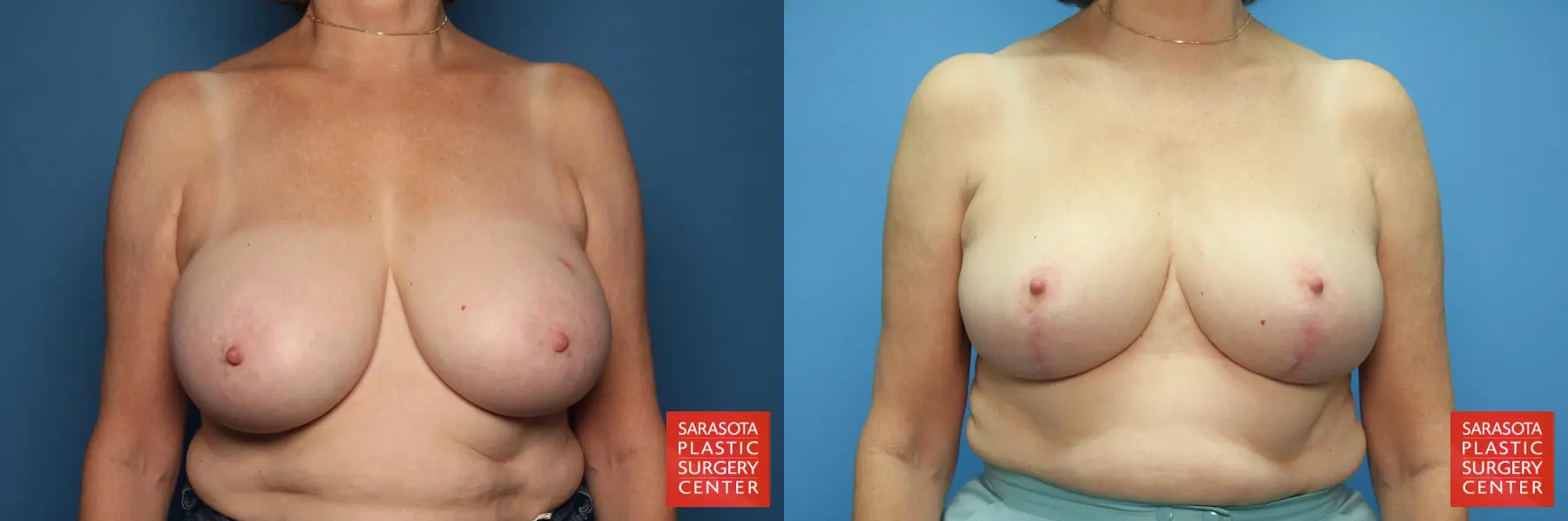 Breast Reduction: Patient 9 - Before and After  
