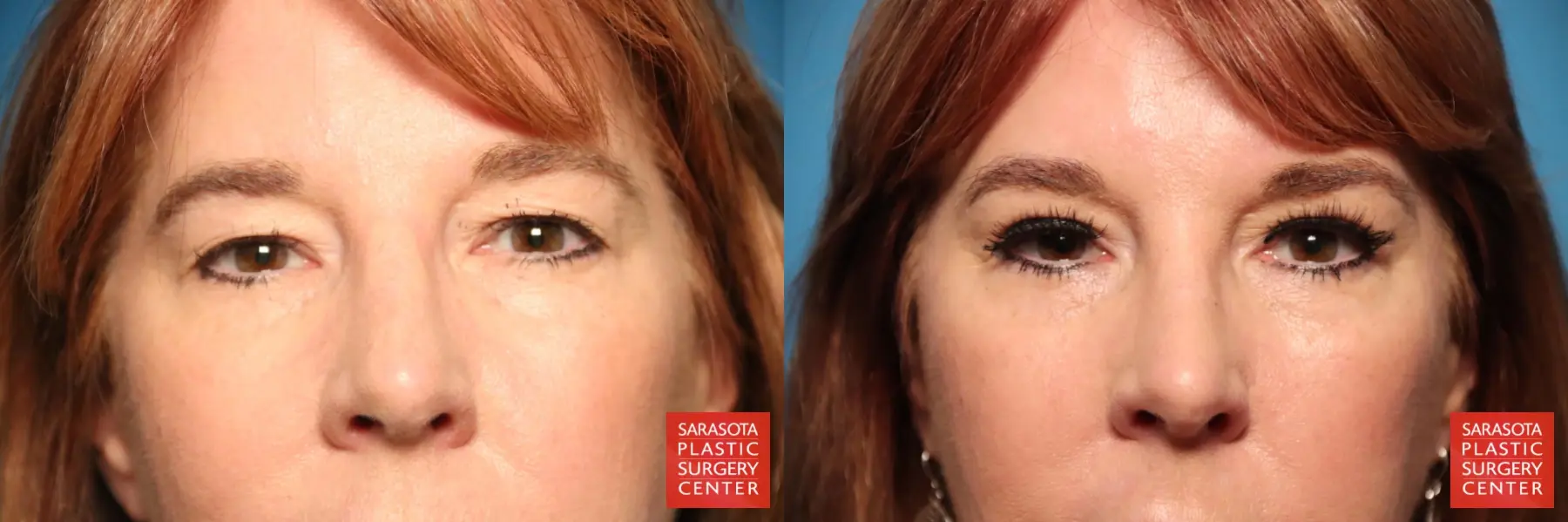 Brow Lift: Patient 3 - Before and After  
