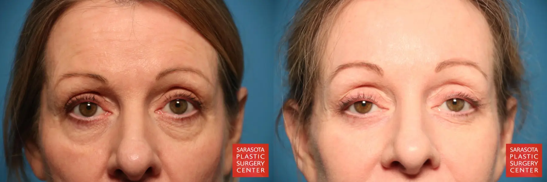 Brow Lift: Patient 7 - Before and After  