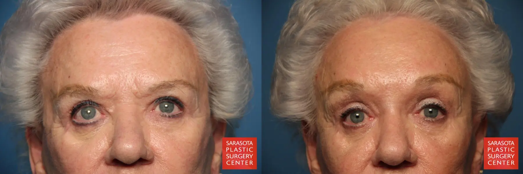 Brow Lift: Patient 5 - Before and After  