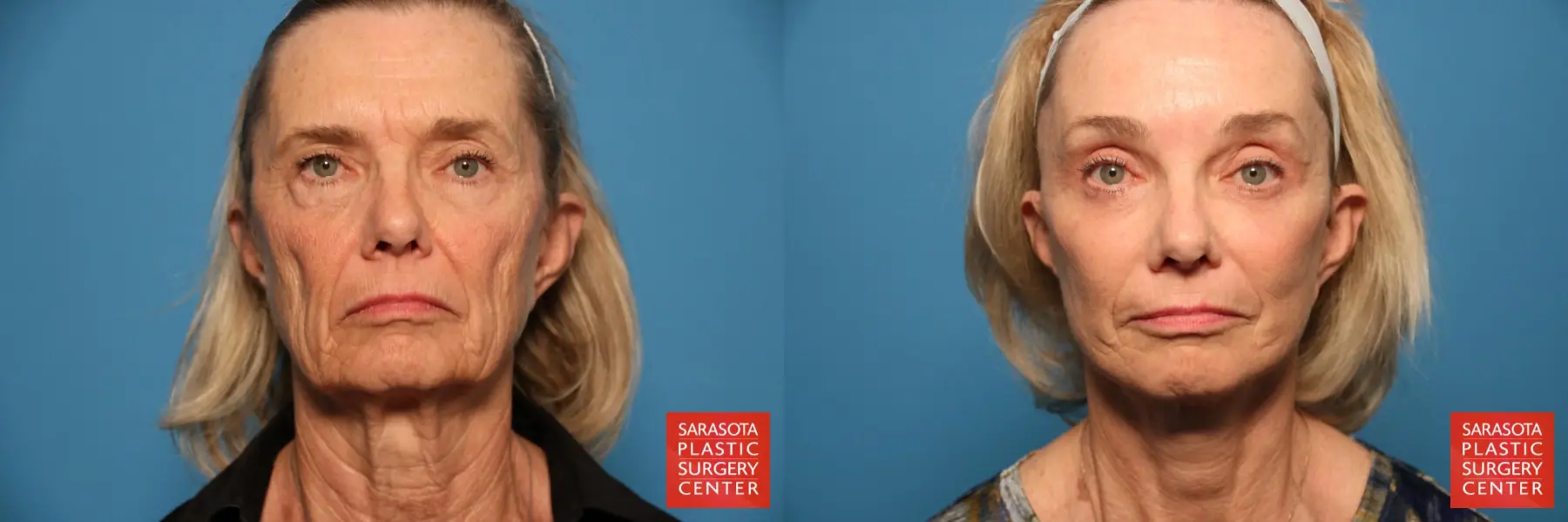 Brow Lift: Patient 4 - Before and After 4