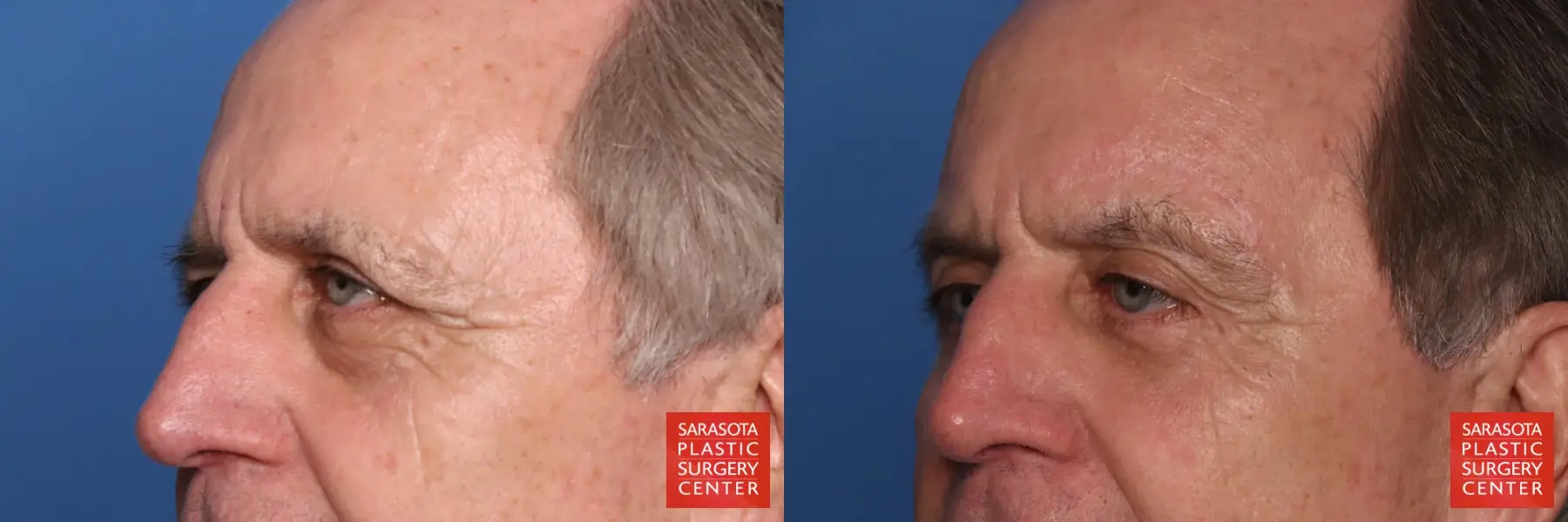 Brow Lift: Patient 10 - Before and After 4