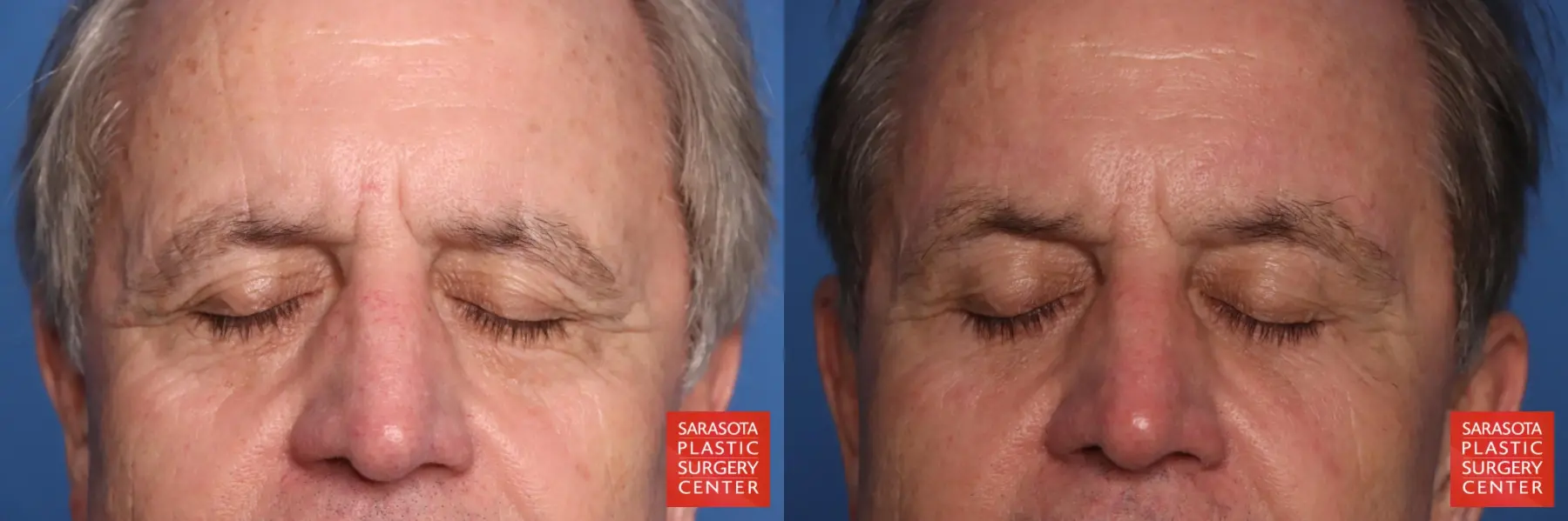 Brow Lift: Patient 10 - Before and After 2