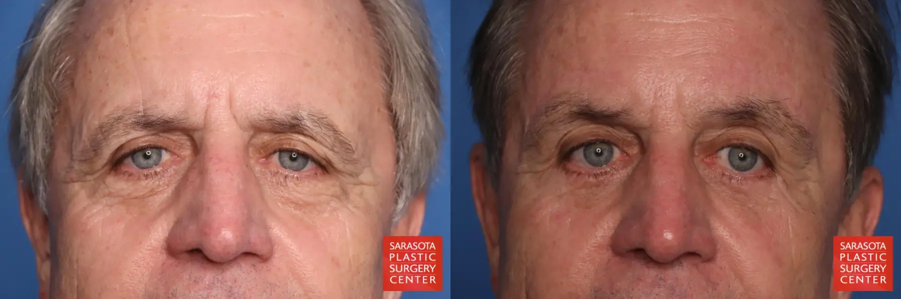 Brow Lift: Patient 10 - Before and After 1