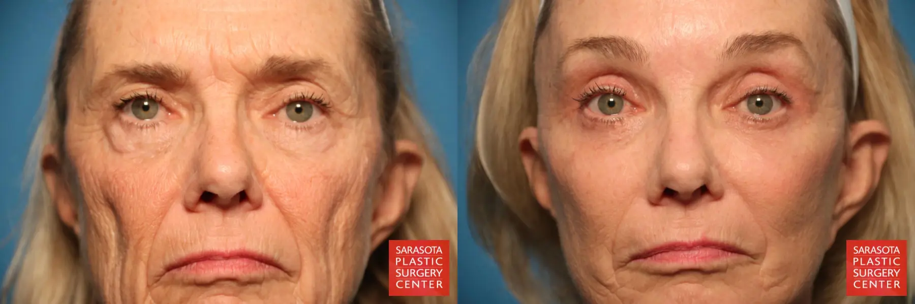 Brow Lift: Patient 4 - Before and After  