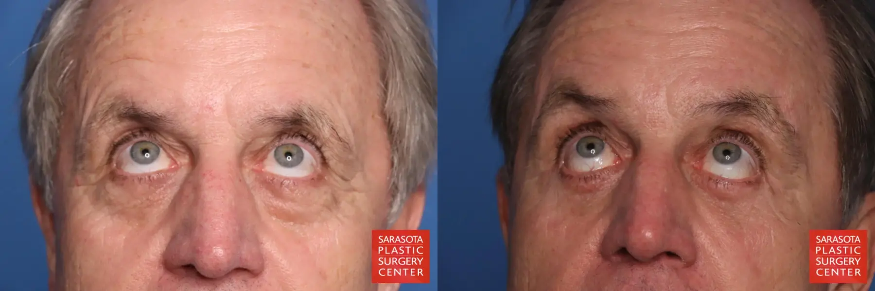 Brow Lift: Patient 10 - Before and After 3