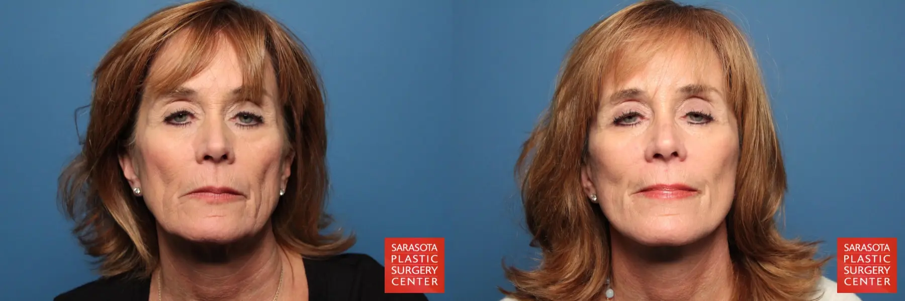 Cheek Lift: Patient 14 - Before and After  