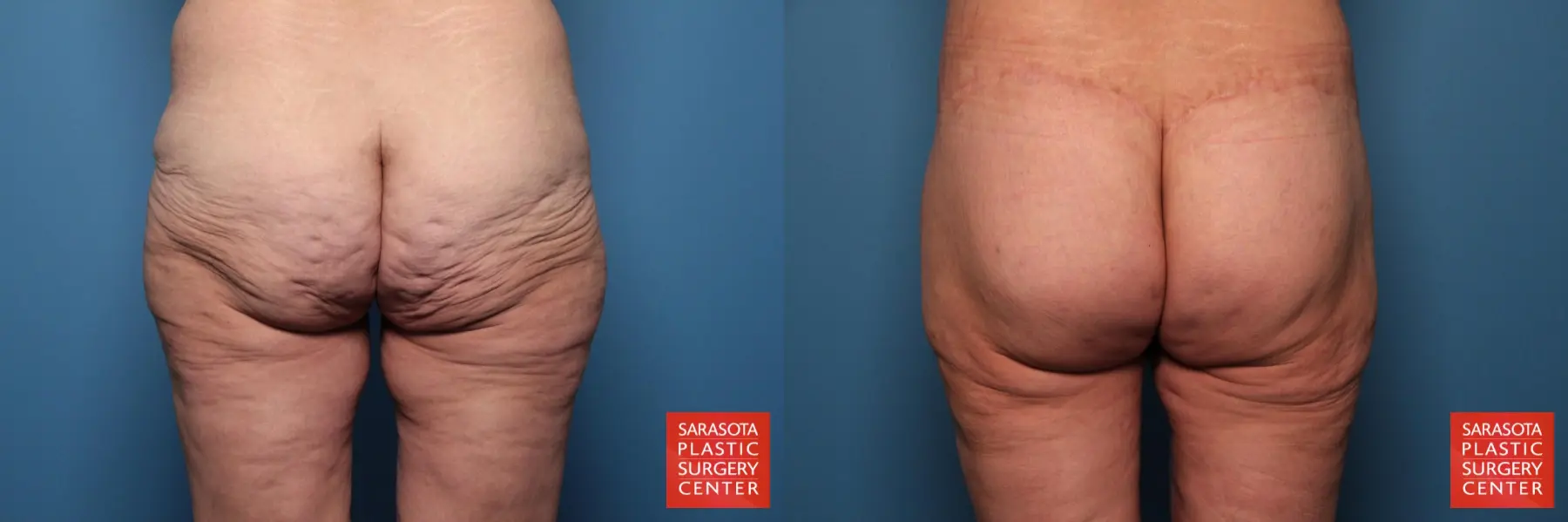 Excisional Buttock Lift: Patient 3 - Before and After  