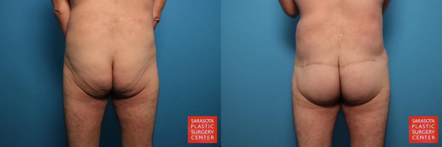 Excisional Buttock Lift: Patient 8 - Before and After  