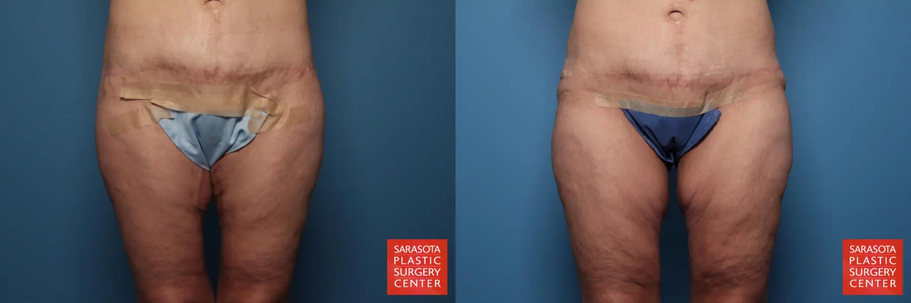 Excisional Buttock Lift: Patient 4 - Before and After 2