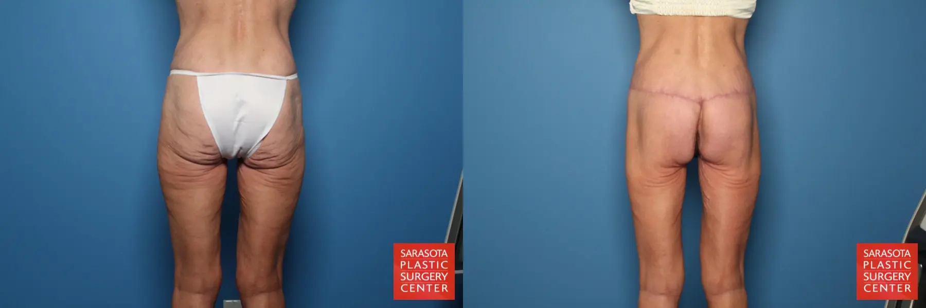 Excisional Buttock Lift: Patient 6 - Before and After  