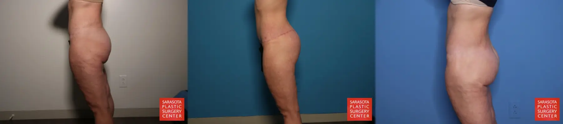Excisional Buttock Lift: Patient 10 - Before and After 3
