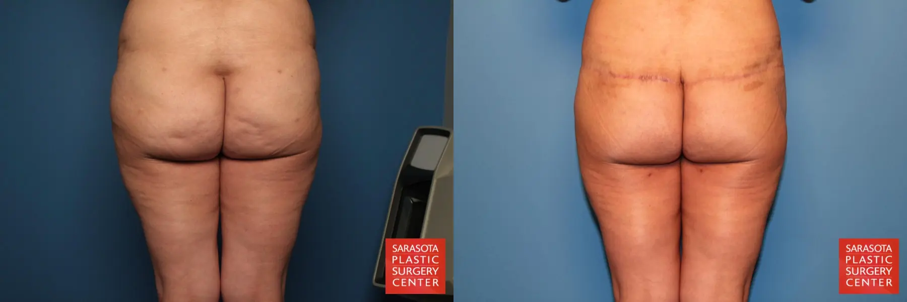 Excisional Buttock Lift: Patient 5 - Before and After  