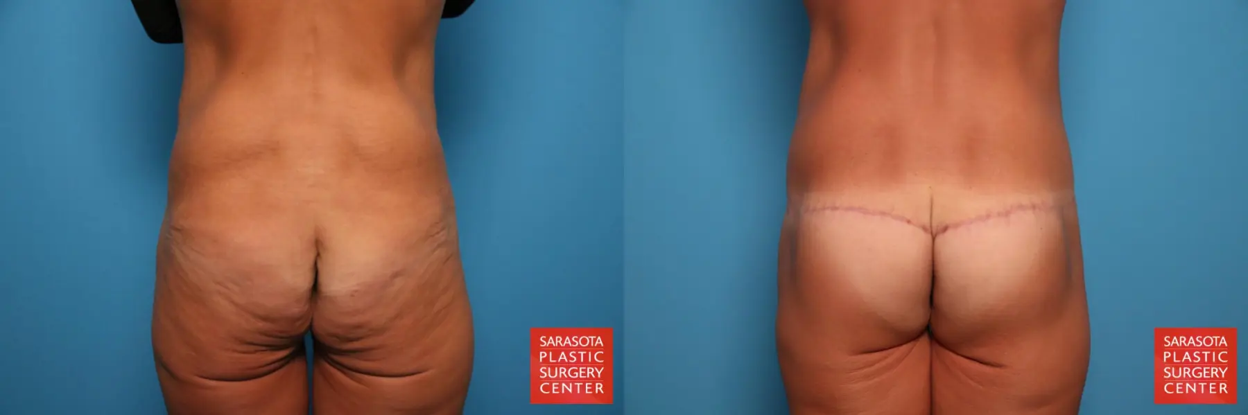 Excisional Buttock Lift: Patient 9 - Before and After  