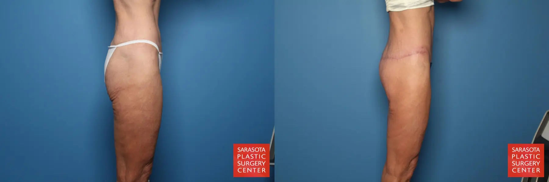 Excisional Buttock Lift: Patient 6 - Before and After 5