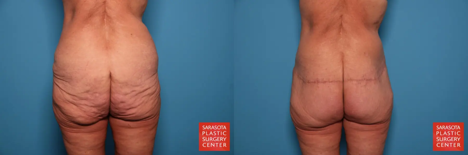 Excisional Buttock Lift: Patient 7 - Before and After  
