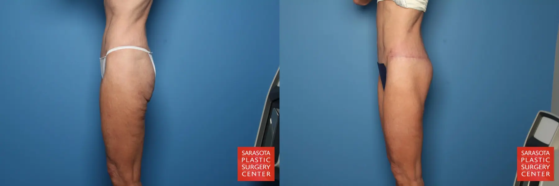 Excisional Buttock Lift: Patient 6 - Before and After 4