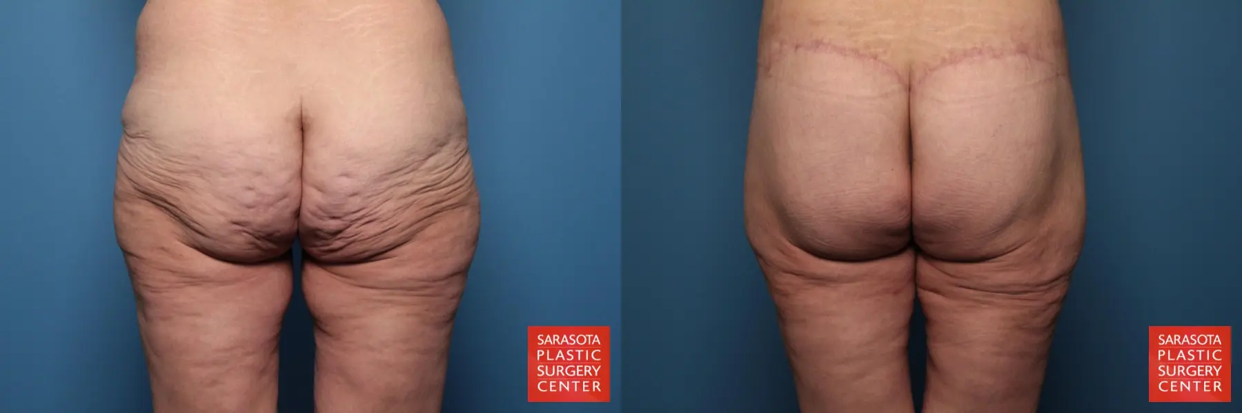 Excisional Buttock Lift: Patient 4 - Before and After  