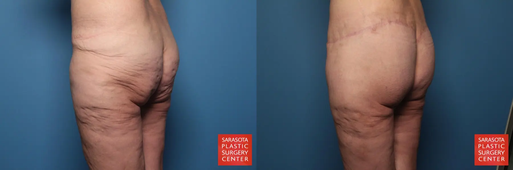 Excisional Buttock Lift: Patient 4 - Before and After 3
