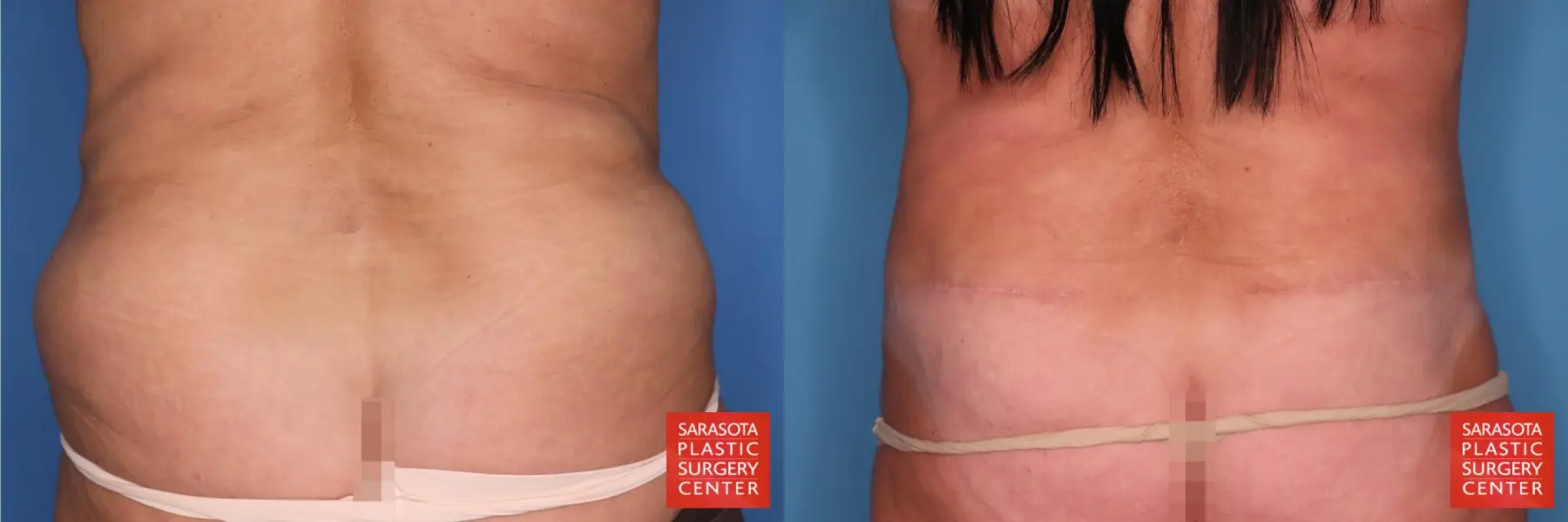 Extended Abdominoplasty: Patient 1 - Before and After  
