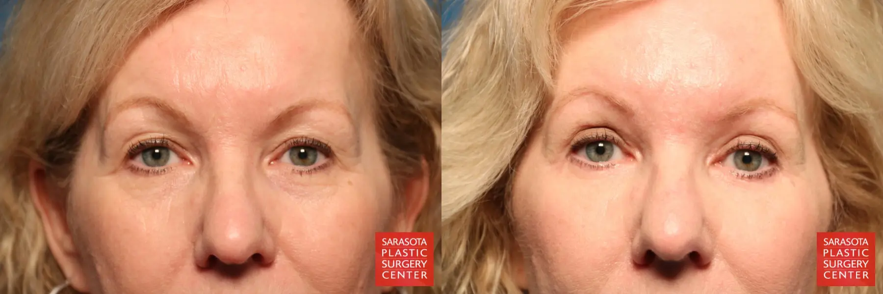 Eyelid Surgery: Patient 31 - Before and After  
