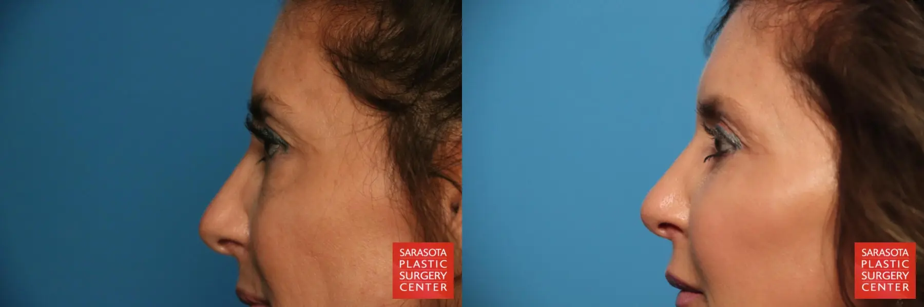 Eyelid Surgery: Patient 6 - Before and After 5