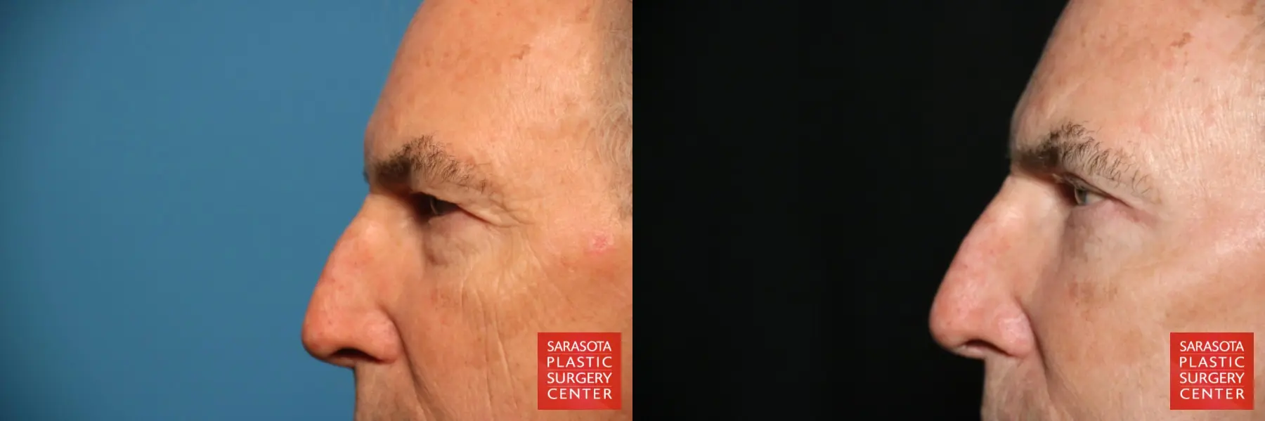 Eyelid Surgery: Patient 7 - Before and After 5