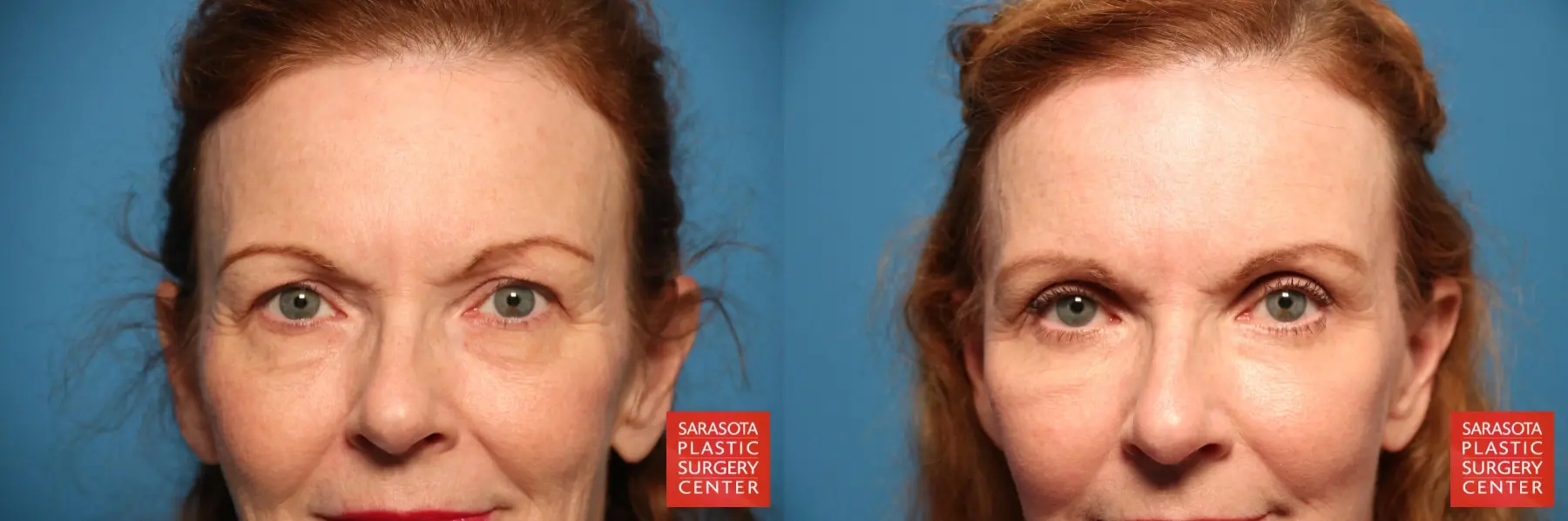 Eyelid Surgery: Patient 22 - Before and After  