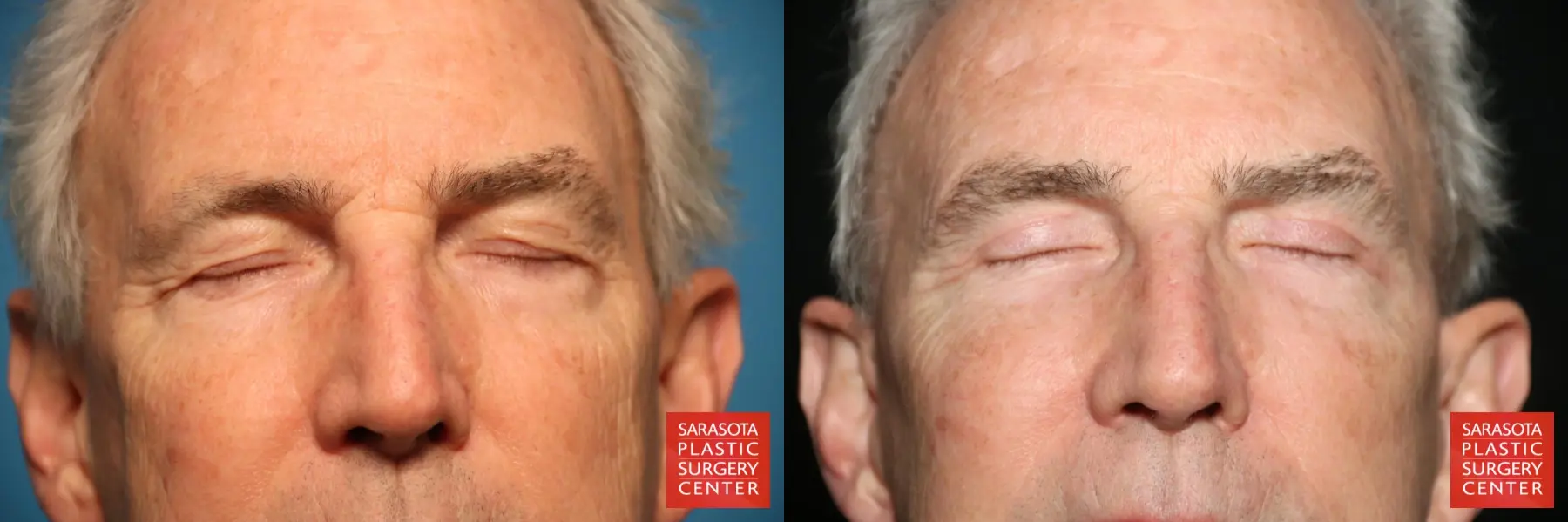 Eyelid Surgery: Patient 7 - Before and After 3