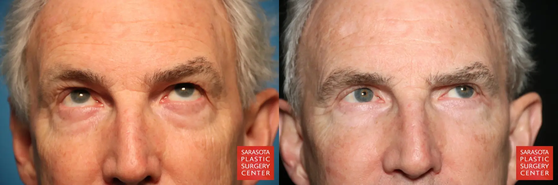 Eyelid Surgery: Patient 7 - Before and After 2